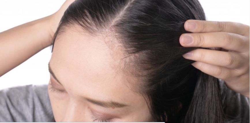 不適合植髮原因1. 整個頭皮區域出現脫髮