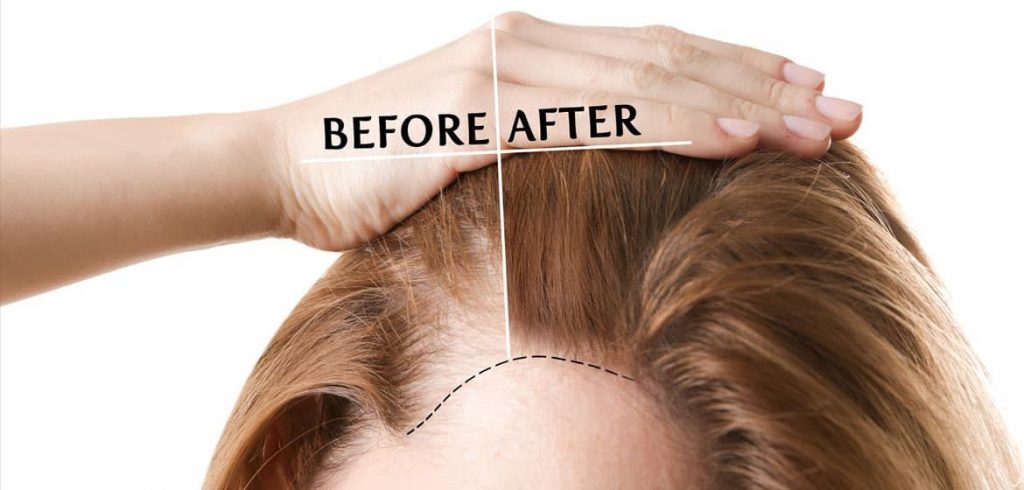 脫髮治療方法1. 植髮手術