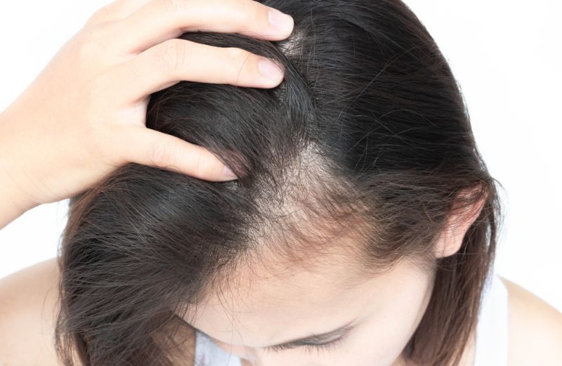 改善脂溢性脫髮方法4. 保持頭皮健康